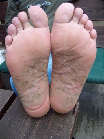 geheilte Füße von Dirk